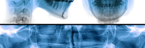 fixed appliance x-ray, orthodontic treatment
