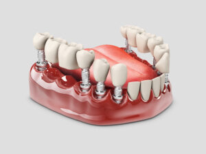 3d Illustration of a Fixed partial denture bridge, isolated white.