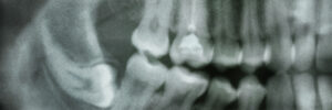 Close-up of dental x-ray. Abnormal location of molar tooth on lower jaw area.