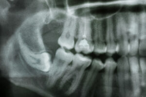 Close-up of dental x-ray. Abnormal location of molar tooth on lower jaw area.
