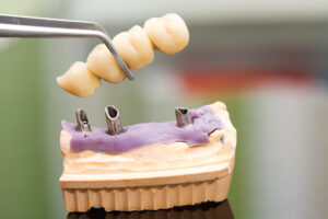 A dentist / dental technician placing the fixed partial denture ( the dental bridge) on the implants.