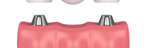 3d render of implants in gums with dental bridge isolated over white background