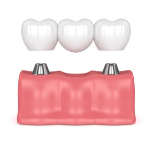 3d render of implants in gums with dental bridge isolated over white background