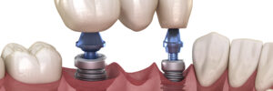 conroe implant dentistry