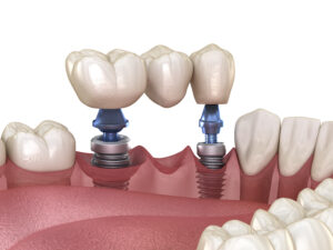 conroe implant dentistry