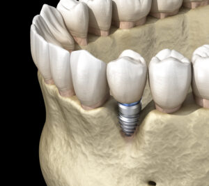 conroe dental implants and crowns