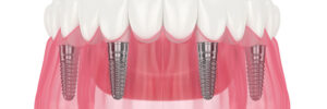 conroe dental prosthetics implants