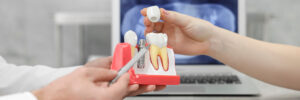 conroe protecting dental implants