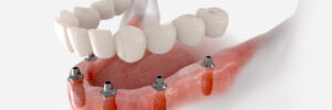 conroe implant dentures