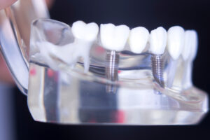 conroe placing dental implants