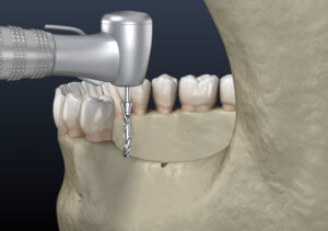 jawbone treatment
