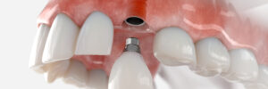 conroe dental implants