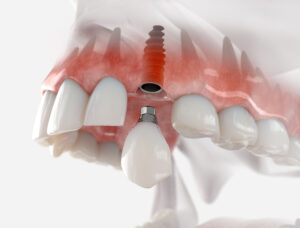 conroe dental implants
