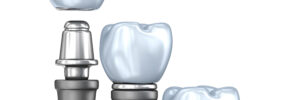 conroe implants and crowns