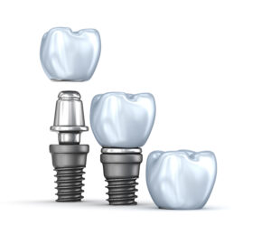 conroe implants and crowns