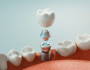 conroe dental implant and crown
